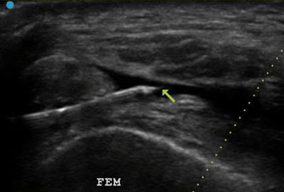 ultrasound image of knee with needle placement